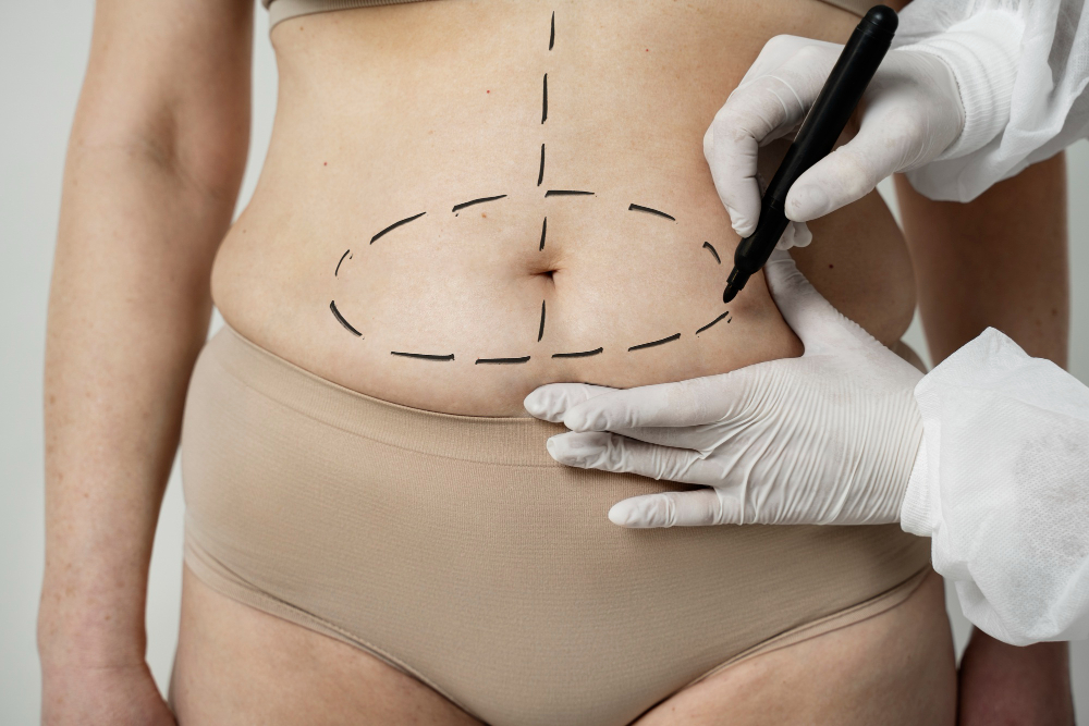 Mini Tummy Tuck