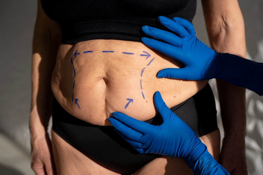 Tummy Tuck