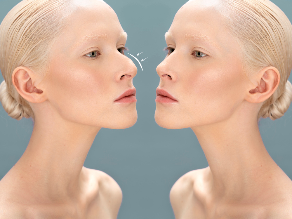 Nose Surgery (Rhinoplasty)