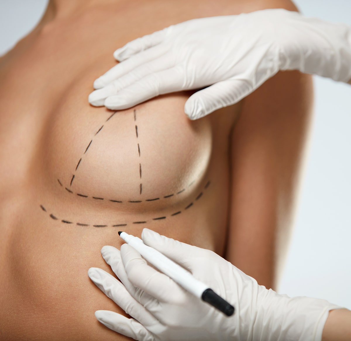 Correction of Breast Asymmetry