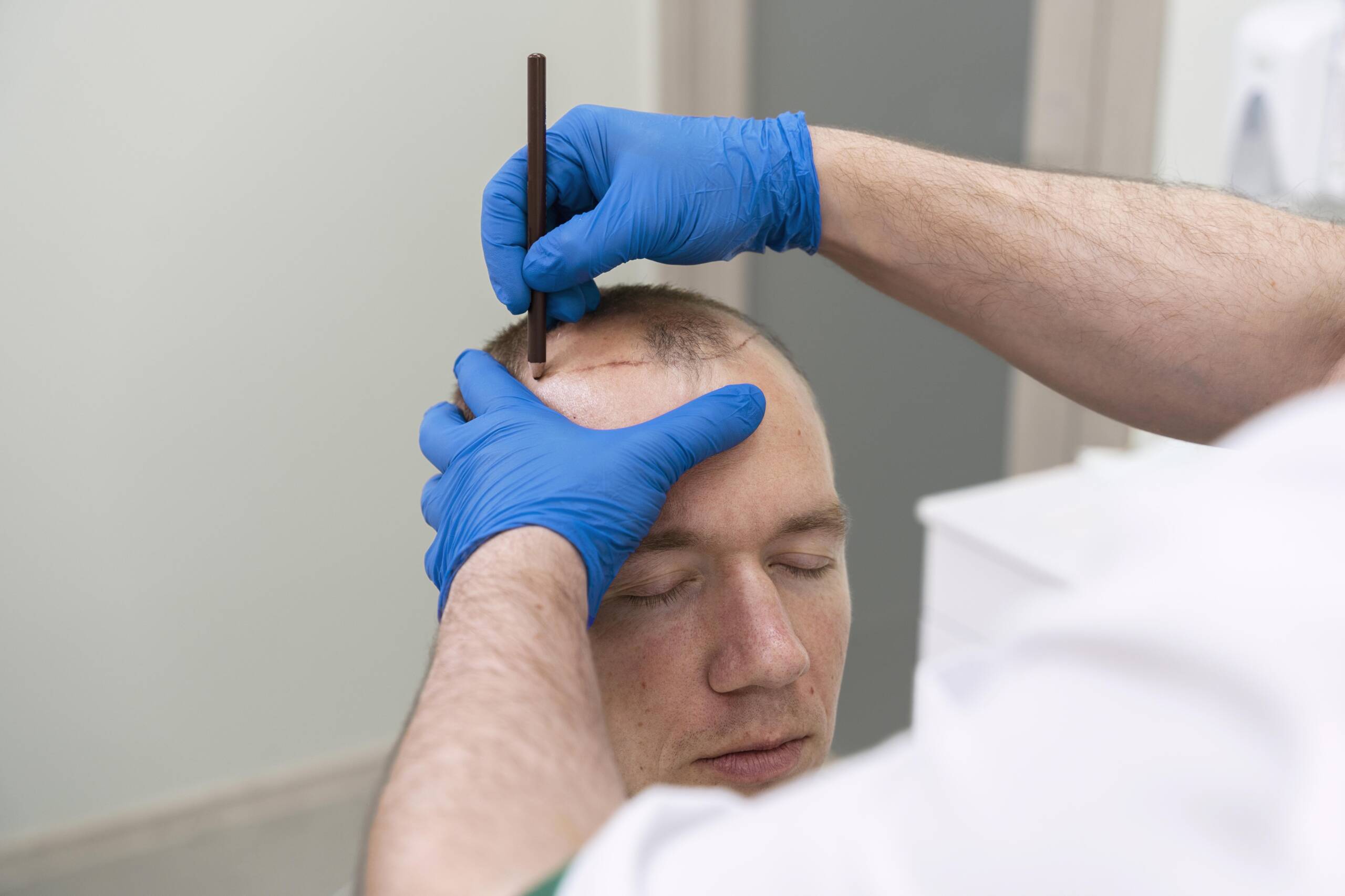 Safir FUE Hair Transplant
